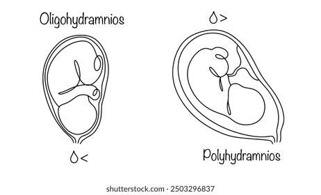 A condition in which the amount of amniotic fluid is less or more than the norm for a given gestational age. Medical illustration on the topic of childbearing and childbirth. Vector illustration.