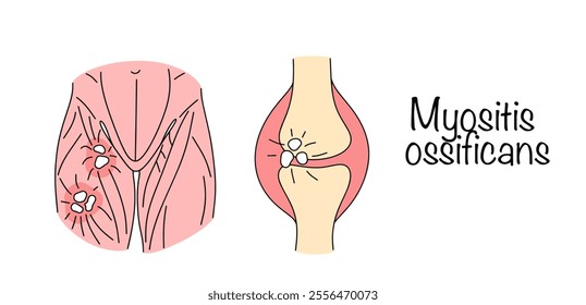 A condition in which bone tissue forms within muscle or other soft tissue after injury. Drawn muscles and joint damaged by myositis ossificans. Colored medical vector.