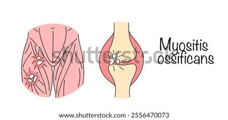 A condition in which bone tissue forms within muscle or other soft tissue after injury. Drawn muscles and joint damaged by myositis ossificans. Colored medical vector.