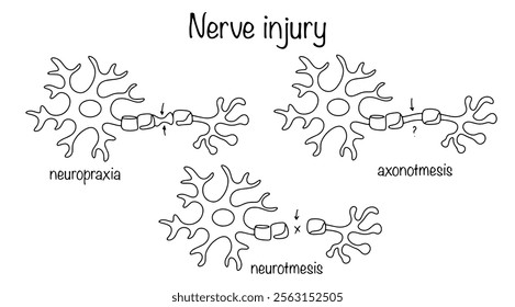 A condition in which nerve fibers become damaged, which can disrupt the transmission of signals along the nerve. The main types of neuronal damage drawn in a continuous line. Vector illustration.