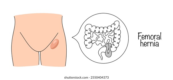 Uma condição em que parte ou todo o órgão abdominal se projeta através do canal femoral. Manifestação externa atraída da doença e causa interna da protrusão. Vetor médico simples.