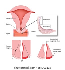 Cervical Biopsy Hd Stock Images Shutterstock