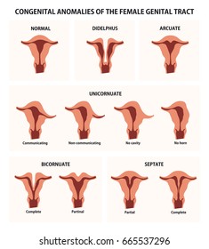 Congenital anomalies of the female genital tract