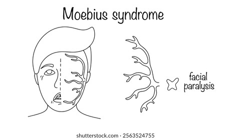 A congenital anomaly characterized by a lack of facial expression. The pathology is characterized by paralysis of the facial nerve. A simple illustration for medical use. 