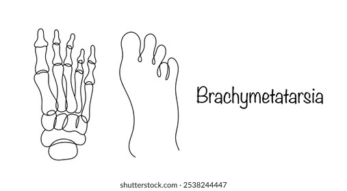 Anomalia congênita do desenvolvimento de um ou mais ossos metatársicos do pé, manifestada pelo encurtamento. Uma ilustração mostrando danos ósseos e como eles se parecem em uma perna humana. Vetor.