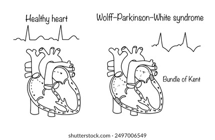 Anomalía congénita de la estructura del corazón, en la cual una persona tiene un sistema de conducción miocárdica adicional. Dibujado corazón sano y el corazón de una persona enferma. Síndrome de Wolff-Parkinson-White.