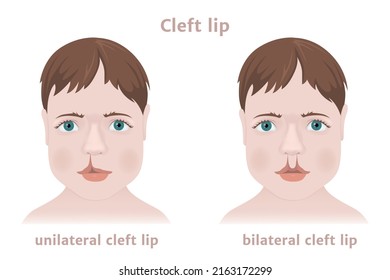 Congenital childhood pathology cleft lip. One-sided and two-sided. Realistic face. Medical poster. Vector illustration