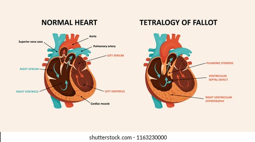 Congenital Disease Of The Heart: Ventricular Septal Defect,
Right Ventricular Hypertrophy,
Pulmonic Stenosis