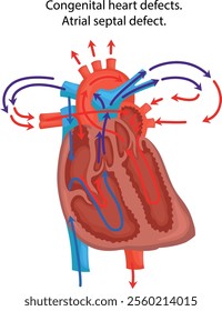 Congenital heart defects. Atrial septal defect.