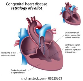 Congenital Heart Disease Tetralogy Fallot Stock Vector (Royalty Free ...