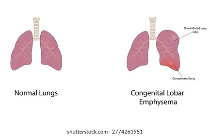 Congenital lobar emphysema vector illustration
