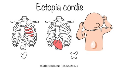 A congenital malformation characterized by an abnormal location of the heart outside the chest cavity. Drawing of the correct and incorrect anatomical location of the heart. Vector illustration.