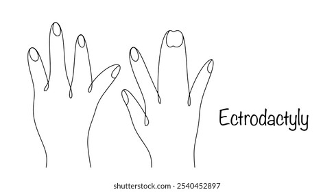 A congenital malformation of the hands, characterized by the absence or underdevelopment of one or more fingers. Manifestation of the disease ectrodactyly. Vector illustration.