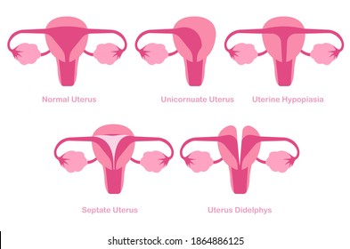 Congenital mullerian anomalies or uterine abnormalities concept illustration. Female reproductive condition.