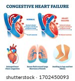 Congestive heart failure vector illustration. Labeled medical problem vs healthy organ comparison scheme. Illness symptoms infographic with educational dilated ventricle, cardio oxygen supply diagram.