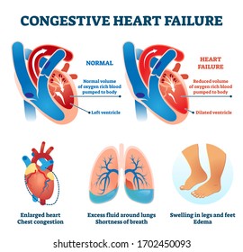 Congestive Heart Failure Vector Illustration. Labeled Medical Problem Vs Healthy Organ Comparison Scheme. Illness Symptoms Infographic With Educational Dilated Ventricle, Cardio Oxygen Supply Diagram.