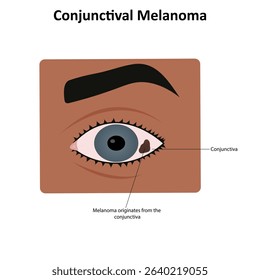 Conjunctival melanoma in the eye vector illustration