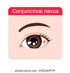 Conjunctival nevus  (stains on the eyeballs) vector illustration