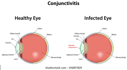 Conjunctivitis