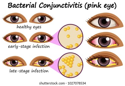 Conjunctivitis, bacterial. Process and anatomy.