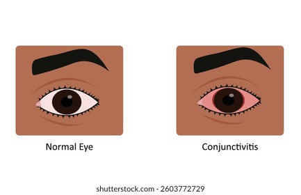 Conjunctivitis eye disease vector illustration