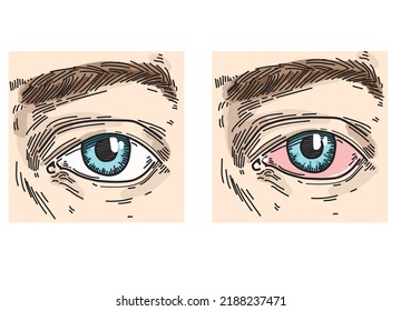 conjunctivitis eyes disease sore eye face expression look watching symbol isolated on white background