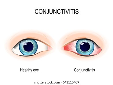 Conjunctivitis. Healthy eye and pink eye (with inflammation).
