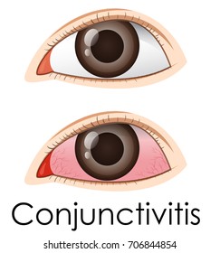 Conjunctivitis Human Eyes Illustration Stock Vector (Royalty Free ...