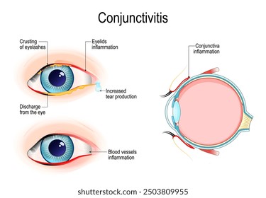 Conjuntivitis. Ojo rosado. Sección transversal de los párpados humanos con inflamación conjuntiva. Ojo con costra de pestañas, secreción del ojo, aumento de la producción de lágrimas, inflamación de los vasos sanguíneos