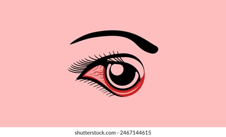 Conjunctivitis, pink eye, flat color illustration