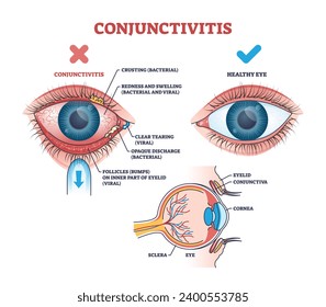 Conjunctivitis pink eye medical condition explanation outline diagram. Labeled educational scheme with healthy lens comparison with virus or bacterial infection and inflammation vector illustration.