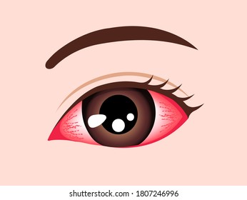 Conjuntivitis (ojo rosa) ilustración vectorial