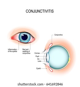 Conjunctivitis. pink eye (with inflammation). External View and Vertical section of the human eyes and eyelids. Schematic diagram. detailed illustration