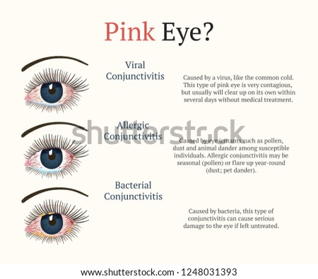 Conjunctivitis, pink eyes. Eye disease. Ophthalmology flat health illustration. Most common conjunctivitis types. Vector.