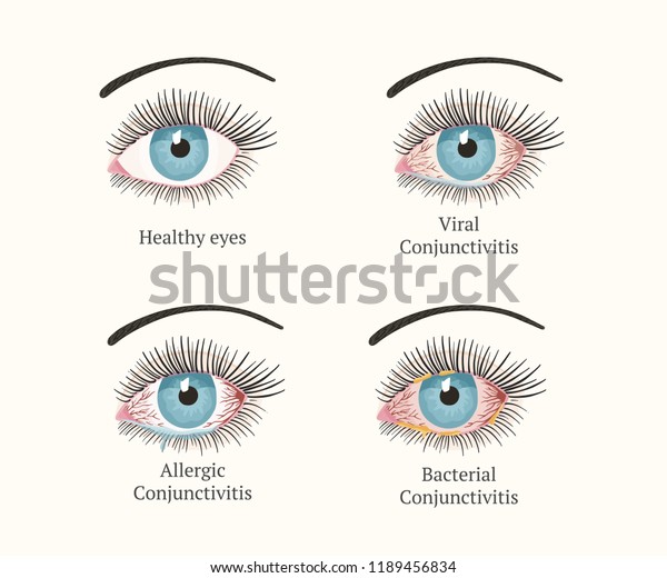 Conjunctivitis Pink Eyes Eye Disease Ophthalmology Stock Vector ...