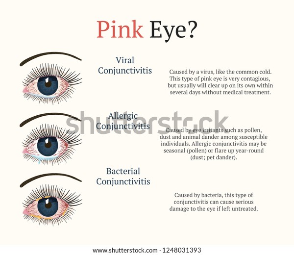Conjunctivitis Pink Eyes Eye Disease Ophthalmology Stock Vector