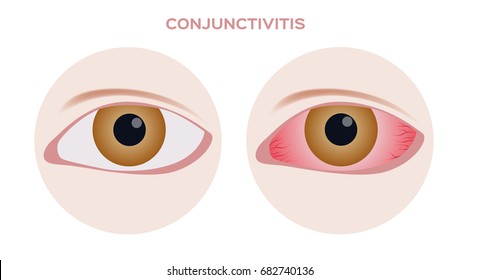 Conjunctivitis.  pink and red inflammation eye 