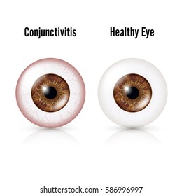 Conjunctivitis. Red Eye. Healthy Eye And Eyeball with Conjunctivitis. Vector Illustration

