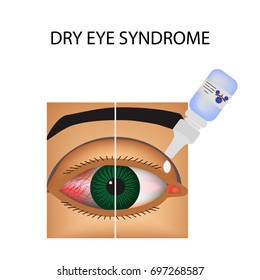 Conjunctivitis. Redness and inflammation of the eye. Vessels. Eye drops. Treatment. Infographics. Vector illustration on isolated background.