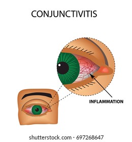 Conjunctivitis. Redness and inflammation of the eye. Vessels in the eye. Infographics. Vector illustration on isolated background.