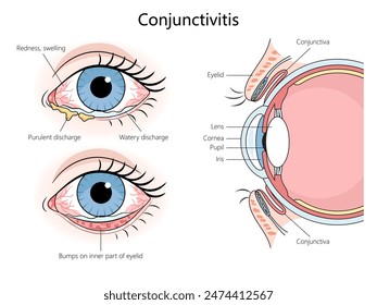 conjunctivitis symptoms and eye anatomy, including redness, swelling, discharge, and bumps on the eyelid diagram hand drawn schematic vector illustration. Medical science educational illustration