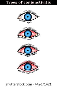 Conjunctivitis types. Inflammatory diseases of eyes.