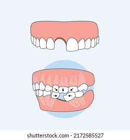 Consequence of not fixing the denture after tooth loss