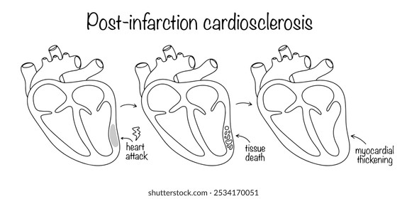 Folgen eines Herzinfarktes in Form von Gewebetod und Verdickung der Myokardwand. Gezeichnete Stadien der Entwicklung der Herzpathologie. Einfache medizinische Vektorgrafik.