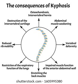 The consequences of kyphosis. Spinal curvature, kyphosis, lordosis, scoliosis, arthrosis. Improper posture and stoop. Infographics. Vector illustration on isolated background.