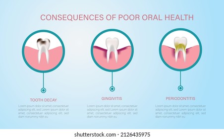 Consecuencias de una mala higiene bucal, caries, gingivitis y periodontitis.