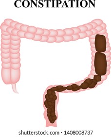 Constipation Feces Colon Infographics Vector Illustration Stock Vector 