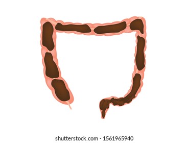 Constipation in intestine / colon vector / stomach
