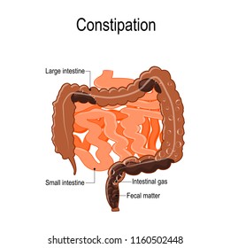 Constipation Vector Illustration Represent Human Intestine Stock Vector ...