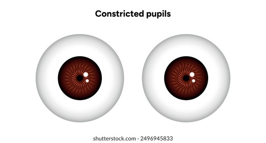 Constricted pupils eye diseases ophthalmology